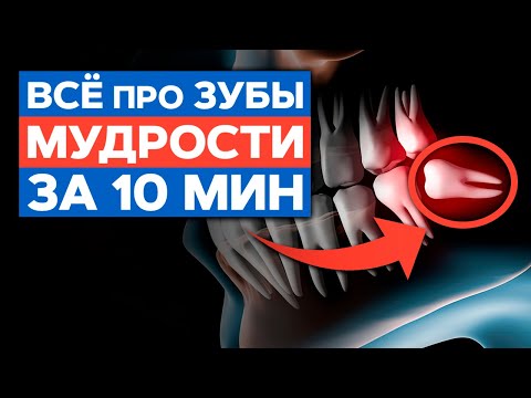 Видео: Когда нужно удалять зубы мудрости? / Показания и последствия удаления зубов