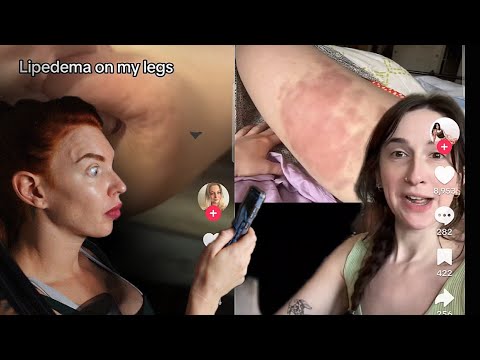 Видео: Не весь жир на ногах — липедема, целлюлит существует. Липедема в TikTok — это безумие.