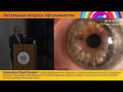 Видео: Фемтокератопластика техника, результаты, осложнения Ю Ю  Калинников