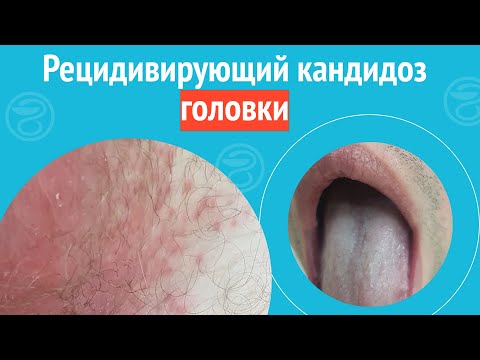 Видео: 😨 Рецидивирующий кандидоз головки. Клинический случай №1363
