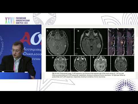 Видео: Стандарты лучевого лечения злокачественных глиом