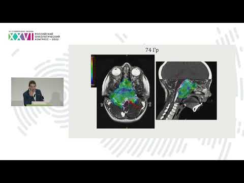Видео: Протонная терапия сарком мягких тканей и костей. Реальная клиническая практика