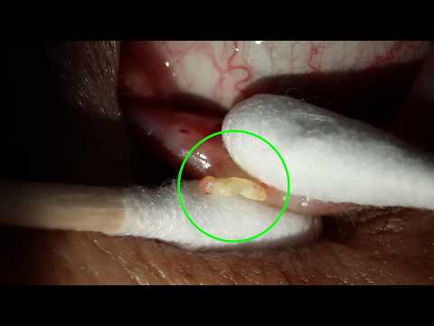 Видео: Удаление ячменя – Почему так затягивает? Эпизод 31