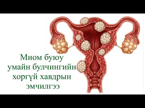 Видео: миомтой хүнд ямар ямар эмчилгээ хийдэг вэ?