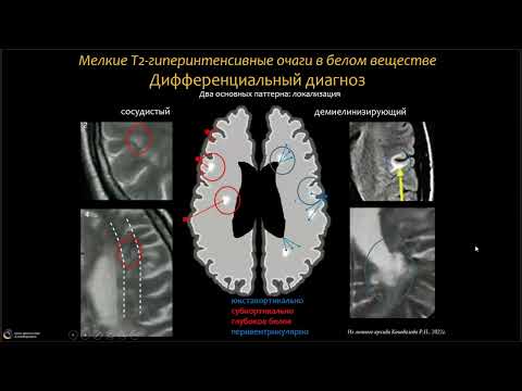Видео: Вебинар МРО РОРР: "Дифференциальная МРТ диагностика при рассеянном склерозе"