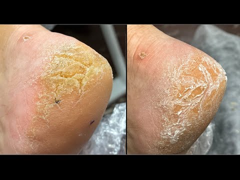 Видео: Гиперкератоз😳/ Работа с пяткой