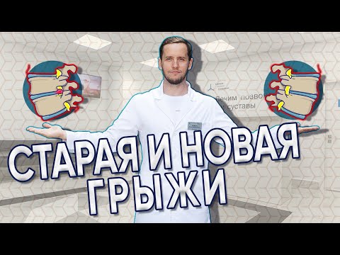 Видео: Отличия старой и новой грыжи | Что будет, если помешать выздоровлению |  Доктор Епифанов