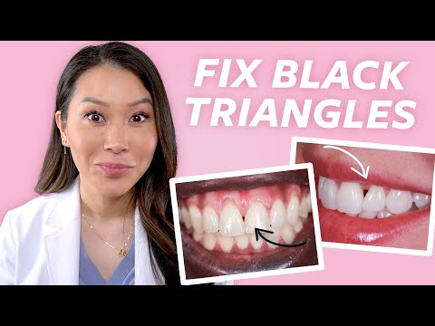 Видео: ИСПРАВЛЕНИЕ щелей между зубами — как убрать чёрные треугольники