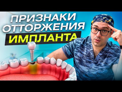 Видео: Признаки отторжения импланта - как распознать и что делать
