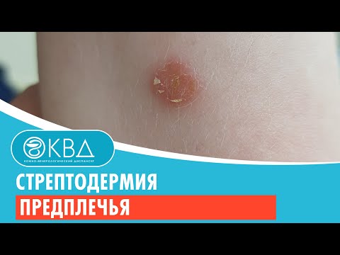 Видео: 😐 Стрептодермия предплечья. Клинический случай №274