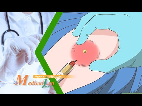 Видео: Постинъекционный абсцесс: возможные причины появления и лечение