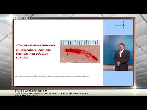 Видео: Класификация на мозъчни тумори с глиална диференциация       минало и настояще