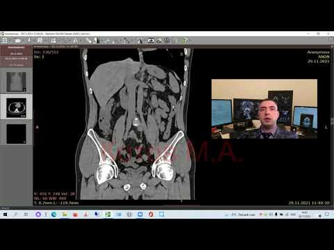 Видео: Дивертикулез толстой кишки. Ролик №9.