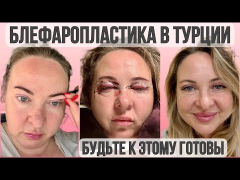 Видео: Блефаропластика в Турции. Будьте к этому готовы. Стоит ли делать? Сколько стоит?