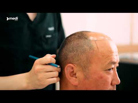 Видео: 🟢Үс шилжүүлэн суулгах мэс ажилбарын дараах шууд үр дүн