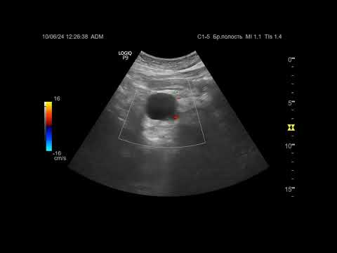 Видео: УЗИ. Доктор Иогансен. Видеопримеры. Выпуск 104. Киста поджелудочной железы (2).