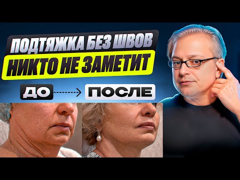 Видео: Безрубцовая подтяжка лица.