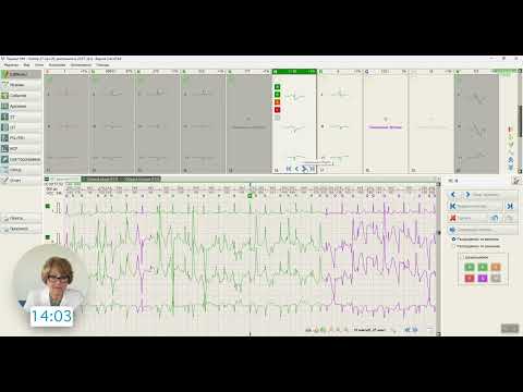 Видео: Расшифровка Холтера БТЛ за 20 минут