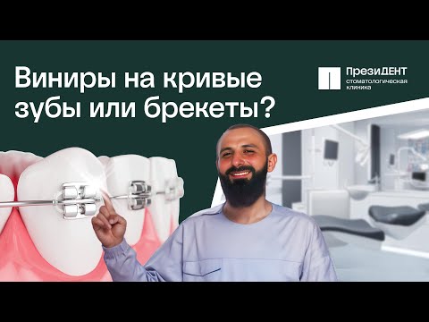 Видео: 🔴 Как делают виниры на кривые зубы, в чем плюсы и минусы? Виниры на кривые зубы.