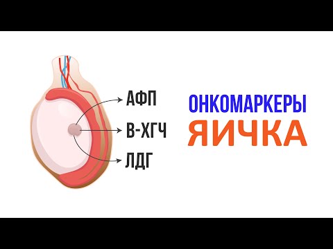 Видео: Рак яичка. 3 главных онкомаркера и их роль в диагностике семиномы и несиминомных опухолей яичка