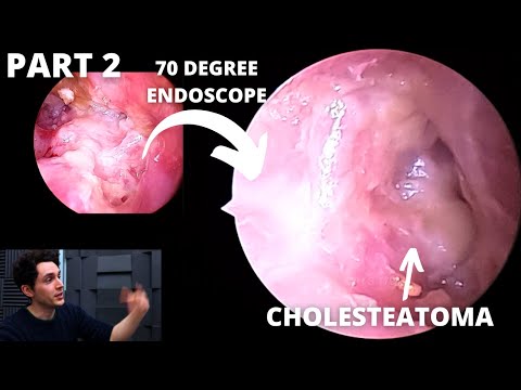 Видео: ОБНОВЛЕНИЕ: Пациент, перенесший инфицированную кондилэктомию сосцевидной полости, вернулся (ЧАСТЬ...