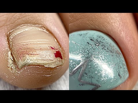 Видео: Первый педикюр в жизни💅 Слоящиеся ногти💅 Вычищаем подногтевую мозоль💅 Педикюр на клиенте