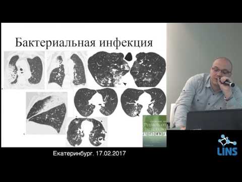 Видео: Коротков П.Б. КТ-паттерны наиболее часто встречающихся поражений легких при ВИЧ-инфекции.