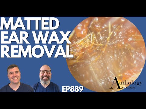 Видео: Удаление слипшейся ушной серы - EP889