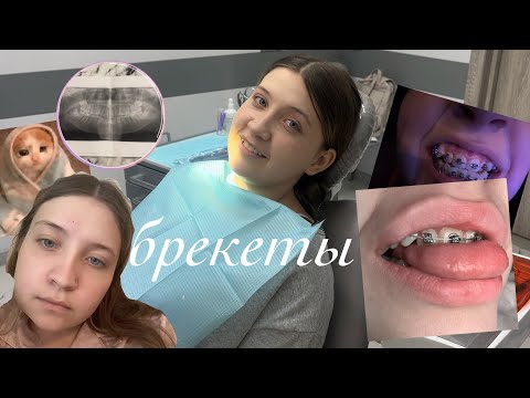 Видео: ставлю брекеты// ОЧЕНЬ ДОЛГО