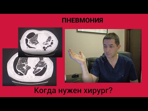 Видео: пневмония. Когда нужен хирург?