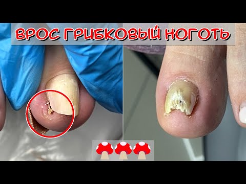 Видео: Вросший ноготь на ноге / Грибок ногтей