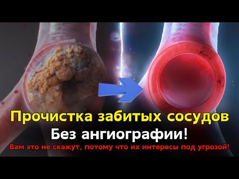 Видео: Больше никаких забитых сосудов, инсульта, и ангио не нужно!