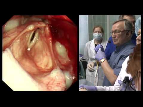 Видео: 16Live Соколов ВВ Стентирование трахеи и правого главного бронха с лазерной модификацией стента
