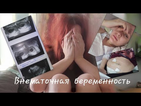 Видео: Внематочная беременность. Моя история. Признаки, что видно на УЗИ.