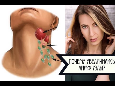 Видео: КОГДА УВЕЛИЧЕННЫЕ ЛИМФ УЗЛЫ ЭТО РАК? АЛГОРИТМ. ПРЯМОЙ ЭФИР