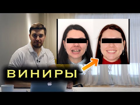 Видео: ВИНИРЫ. Разбор клинического случая