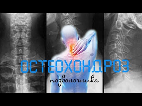 Видео: Рентген: остеохондроз позвоночника