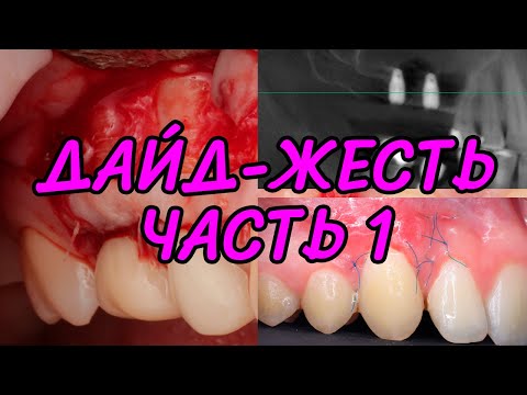 Видео: Дайд-жесть? Часть 1: результаты синуса без графта при гайморите и двух пластик рецессий десны