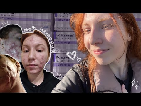 Видео: Моя история лечения акне: тяжёлая степень и ретиноиды ❀