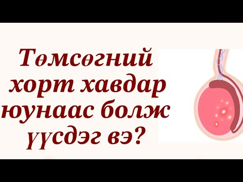 Видео: Эрэгтэйчүүдийн төмсөгний хорт хавдар. 