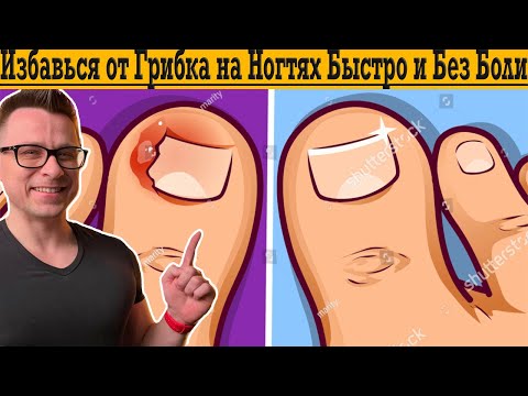 Видео: Как избавиться от грибка на ногтях быстро и безболезненно!