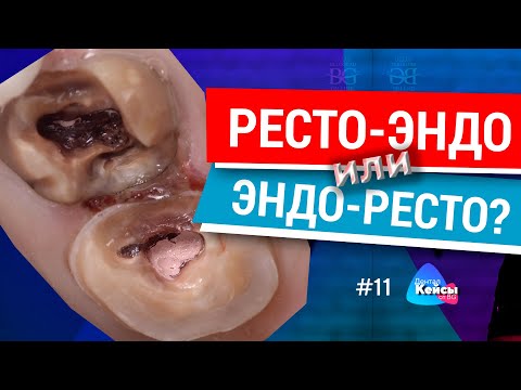 Видео: Ресто-эндо или эндо-ресто? Дентал Кейсы от BG #11