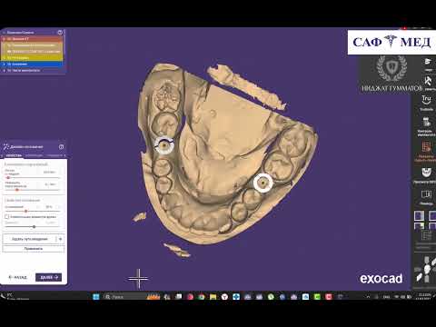 Видео: Хирургический шаблон Exoplan