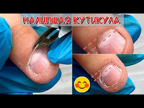 Видео: Налипшая кутикула / Работа с налипшей кутикулой на тонких ногтях