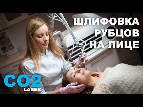 Видео: ШЛИФОВКА рубцов на лице! Обзор СО 2 лазера Medicalaser Pixel!