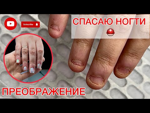 Видео: СГРЫЗЛА НОГТИ 😩 | КАК ВОССТАНОВИТЬ ТАКИЕ НОГТИ? #алена_лаврентьева #nails #ногти #подолог
