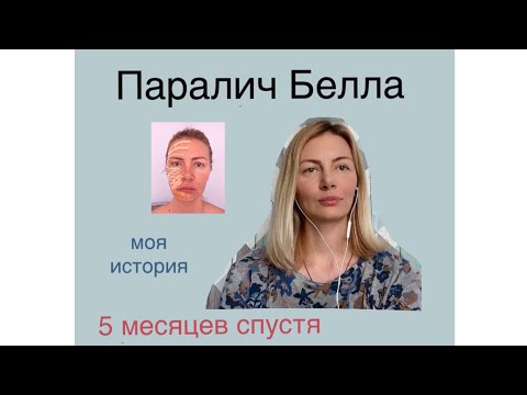 Видео: Неврит лицевого нерва, Паралич Белла