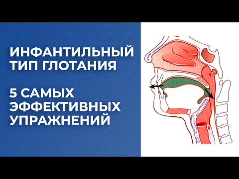 Видео: Инфантильный тип глотания. 5 самых эффективных упражнений