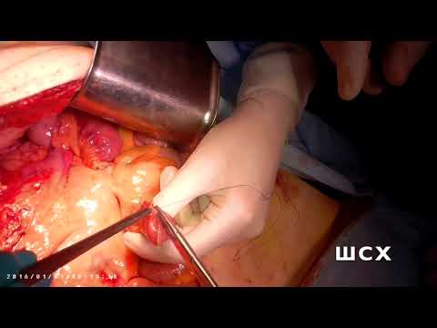 Видео: Ушивание культи