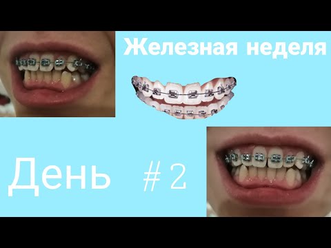 Видео: Железная неделя/ брекеты день #2